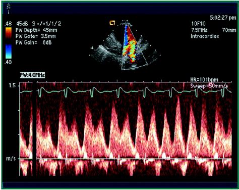 Use Of Intracardiac Echocardiography To Guide Ablation Of Atrial