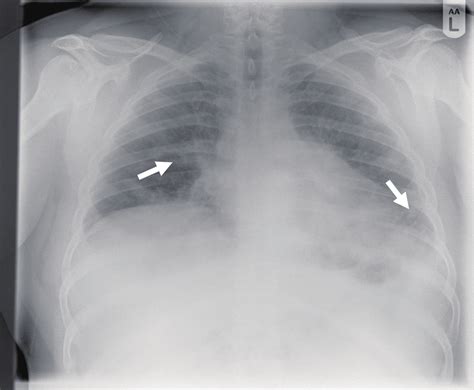 Chest X Ray Showing Patchy Air Space Shadowing In Both Lungs