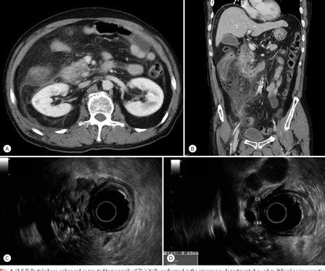 Figure 1 From A Large Hemorrhagic Pseudocyst In Patient With Valproic