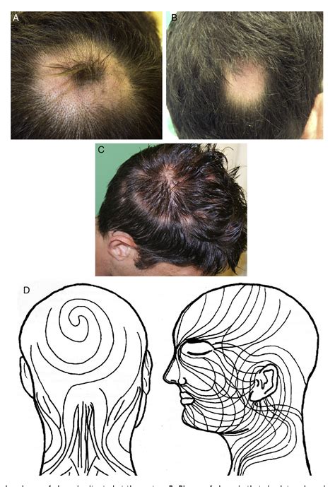 Figure 1 From Linear And Annular Lupus Panniculitis Of The Scalp