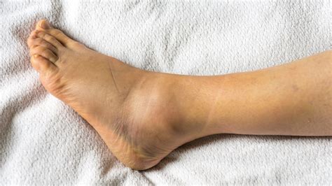 How To Relieve A Swollen Ankle Crazyscreen21