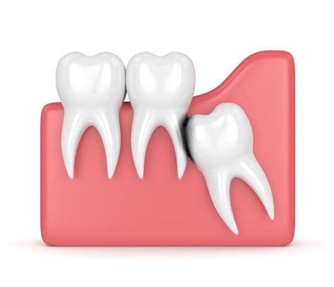 Wisdom Tooth Removal Best Dental Hospital