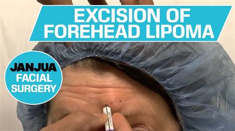 Excision Of Forehead Lipoma Dr Tanveer Janjua New Jersey Youtube