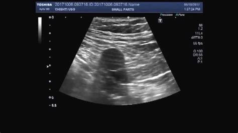Ultrasound Video Showing A Retroperitoneal Small Mass In The Rt Iliac