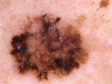 Melanoma Skin Cancer On Back