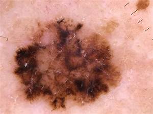 Melanoma skin cancer - Dr. Maksym BreslavetsDr. Maksym Breslavets Skin Cancer  