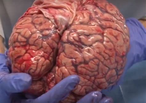 Although her family was unhappy about it at first, they were not completely unreasonable and did not ask min li to disturb yuan's closed cultivation to recruit him, as that would definitely have the opposite. This Video Of A Freshly Removed Human Brain Will Leave You ...