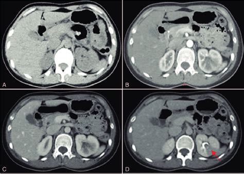 Abdominal Plain Ct Showed No Obvious Abnormalities A Download