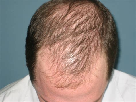 (2014) potential targets in the discovery of new hair growth promoters for androgenic alopecia. OMICS Publishing Group: Various types of Hair Loss