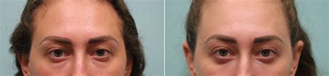 Blepharoplasty Photos Chevy Chase Md Patient 23655