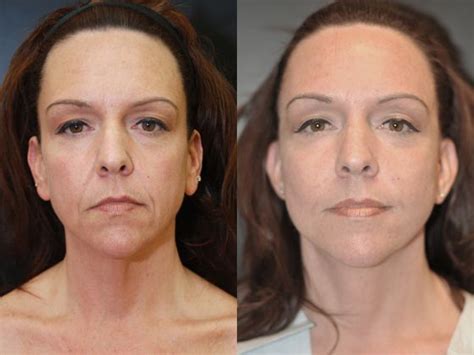 Cheekbone Reshaping Exercise Treatments Use These Facial Gymnastics