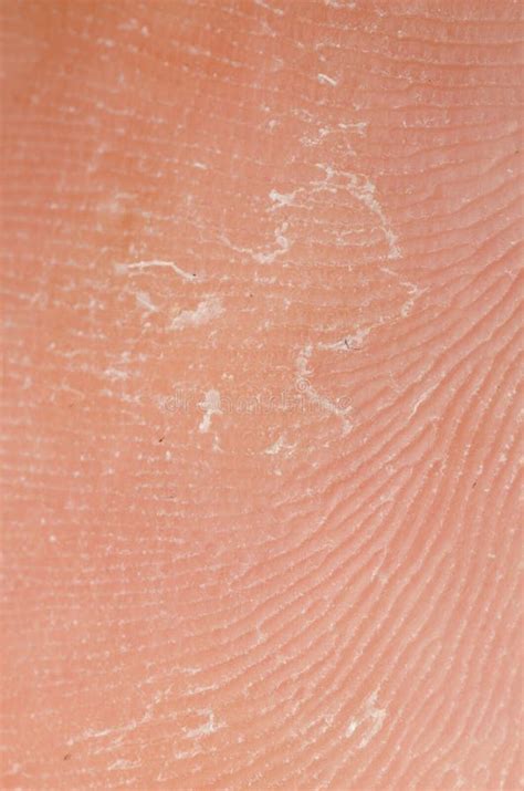 Dry Skin Texture Stock Image Image Of Eczema Dermatitis 18622837