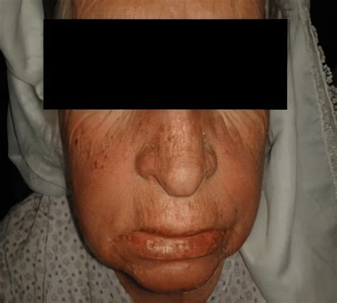 Midfacial Swelling Of The Face And Lips Download Scientific Diagram