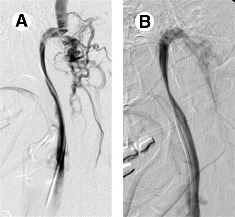 Catheter Venography And Endovascular Treatment Of Chronic Cerebrospinal