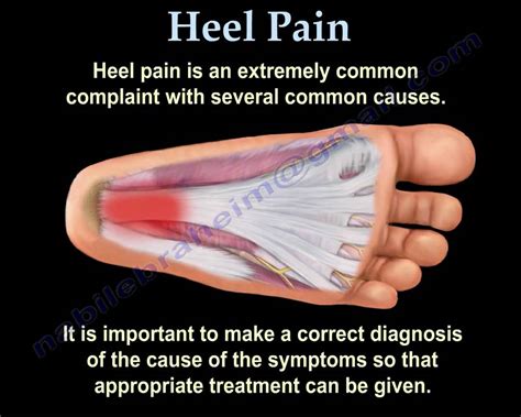 Heel Pain And Plantar Fascitis Everything You Need To Know Dr