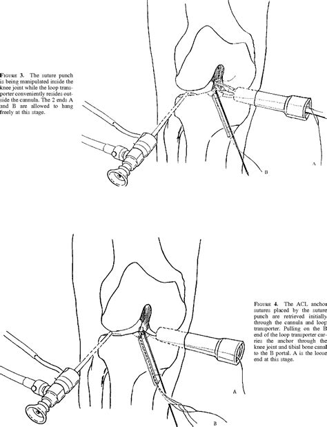 Figure 1 From Modified Arthroscopic Suture Fixation Of Displaced Tibial