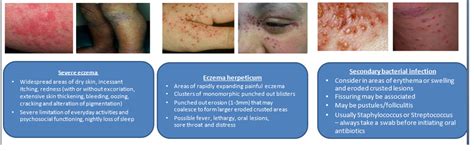 Eczema In Babies Causes Symptoms Triggers And Treatments Eczema Kids