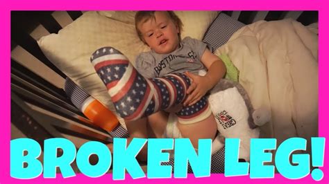 Andrew Broke His Leg Waking Up With A Giant Cast Youtube