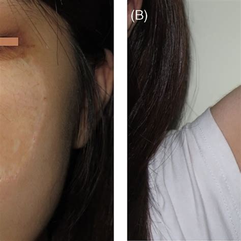 The Patient Is Shown 24 Months After The Procedure The Cheek Scar Was