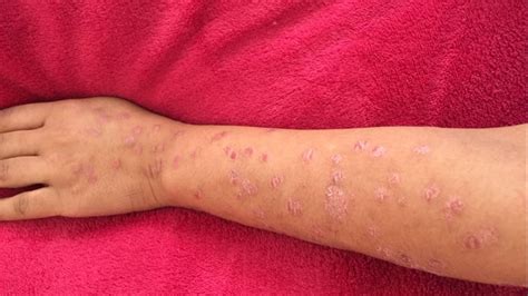 What Life Is Like Dealing With The Skin Condition Psoriasis Bbc News
