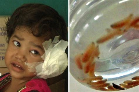 Horrific Pictures Show Girl 4 Having 80 Maggots Removed From Ear Daily Star