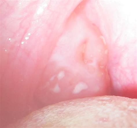 How Common Are Tonsillolith White Tonsils Cancer Lumps