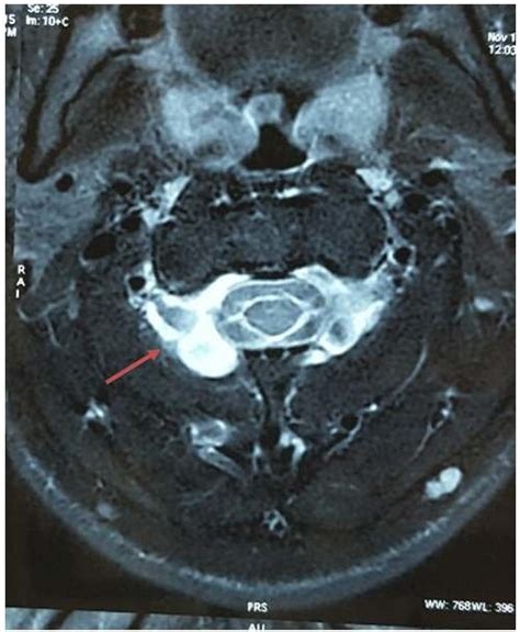 Mri Axial View Of The Occipito Cervical Hinge Showing A High Intensity