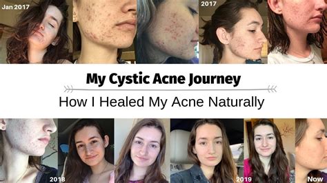 My Cystic Acne Journey How I Healed My Acne Naturally Youtube