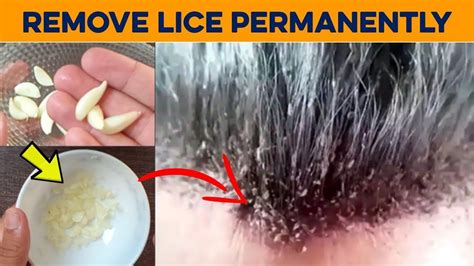 Best Way To Get Rid Of Lice Just For Guide