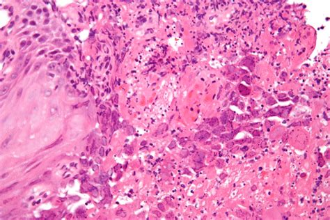 Esophagitis due to herpes simplex virus (hsv) infection1,2. File:Herpes esophagitis - very high mag.jpg - Wikimedia ...
