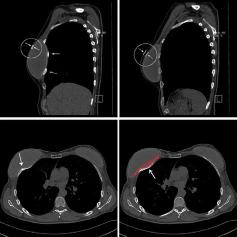 Ct Scan Of The Thorax After The Positioning Of Permanent Anatomically