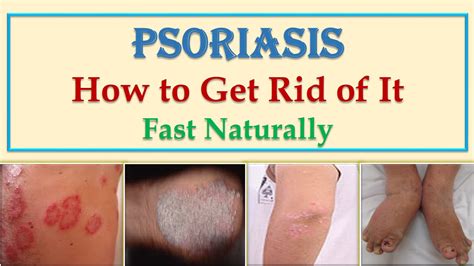 Psoriasis Treatment Natural Healing Is Symptoms What Enhance Itn