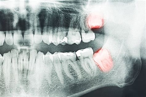 Impacted Wisdom Teeth Causes Health Risks And Treatment Ellwood