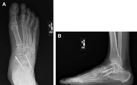 Triple Arthrodesis Foot And Ankle Clinics