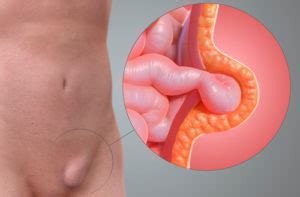 A hiatal hernia describes the upper part of the stomach slipping through the opening in the. » Inguinal Hernias Surgery. No Waiting List. Come to CLINICA BRITANNIA. DR David Costa Navarro ...