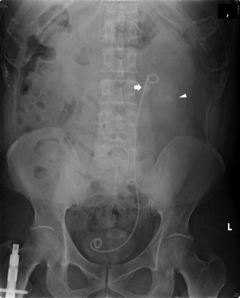 The Kidney Ureter And Bladder Kub X Ray Shows A Retained Stent With