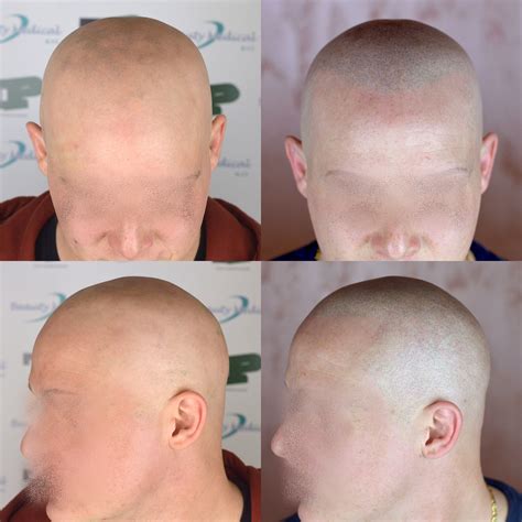 Alopecia universalis is more advanced than alopecia totalis. Case 44 - Tricopigmentation on alopecia totalis / universalis