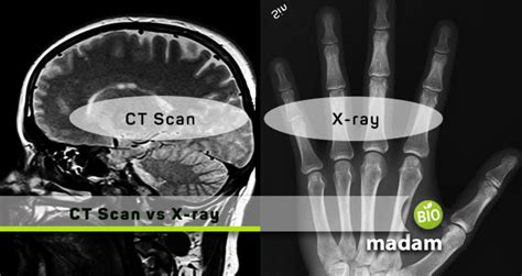 Difference Between Ct Scan And X Ray Biomadam