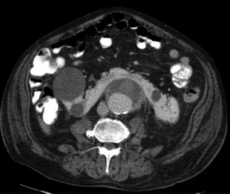 Aneurisma de aorta aneurisma aórtico es un término general para cualquier dilatación o aneurisma de la aorta, usualmente representando una debilidad subyacente. Aneurisma de aorta abdominal con riñón en herradura ...