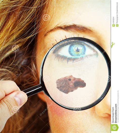 Skin Cancer Stock Photo Image Of Control Blemish Affection 57612314