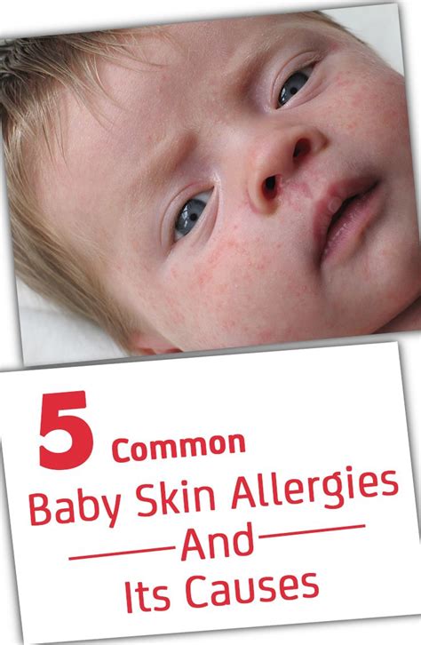 5 Most Common Baby Skin Allergy Symptoms And Its Causes Skin