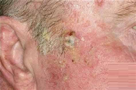 Actinic Keratosis Pictures Treatment Symptoms Causes Prevention