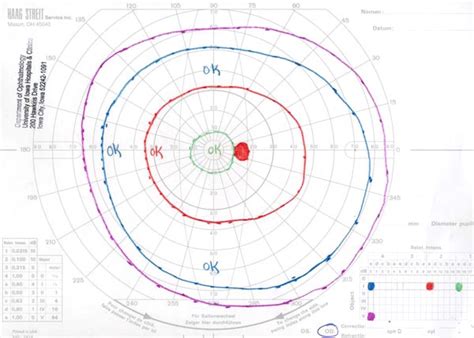 Visual Field Testing From One Medical Student To Another