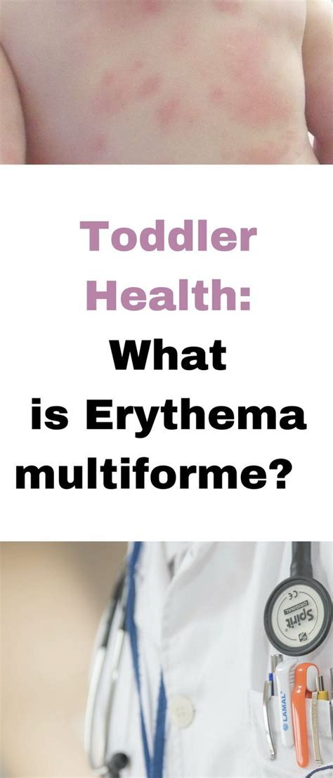 Allergic Erythema Multiforme Reaction To Amoxicillin In Children And