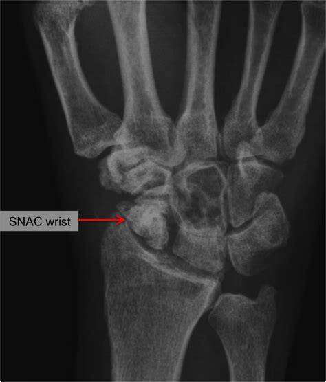 Scaphoid Fracture Raleigh Hand Surgery — Joseph J Schreiber Md