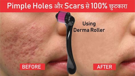 Pimple Holes And Scars Treatment Using Derma Roller 100 Result