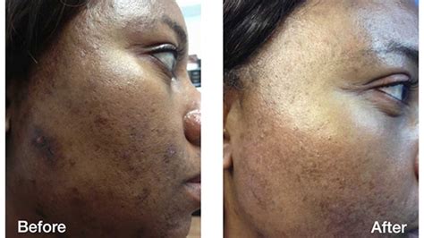 Lagos Big Girl Reveals How Black Spot And Acne Made Her Lose 3 Rich
