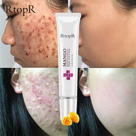 RtopR Acne Treatment Anti Acne Cream Scar Removal Cream @ Best Price