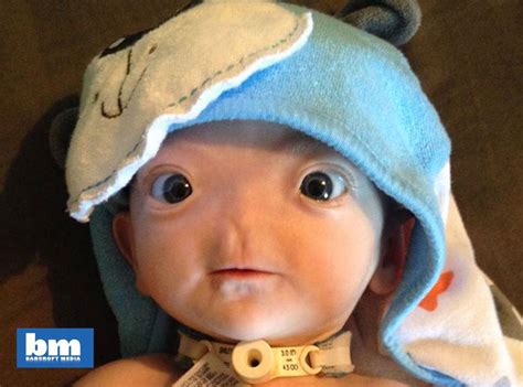 Meet The Adroable Eli The Little Boy Born Without A Nose