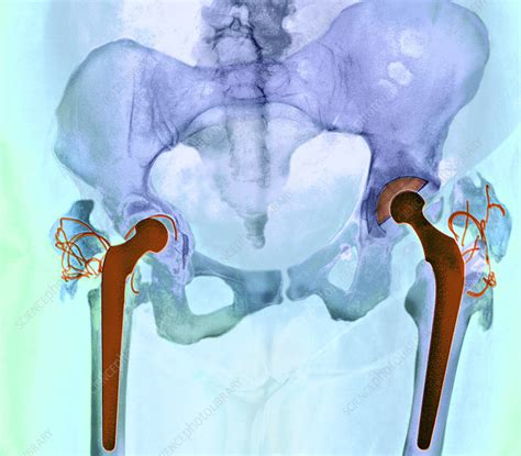 Failed Total Hip Replacement X Ray Stock Image M6000357 Science